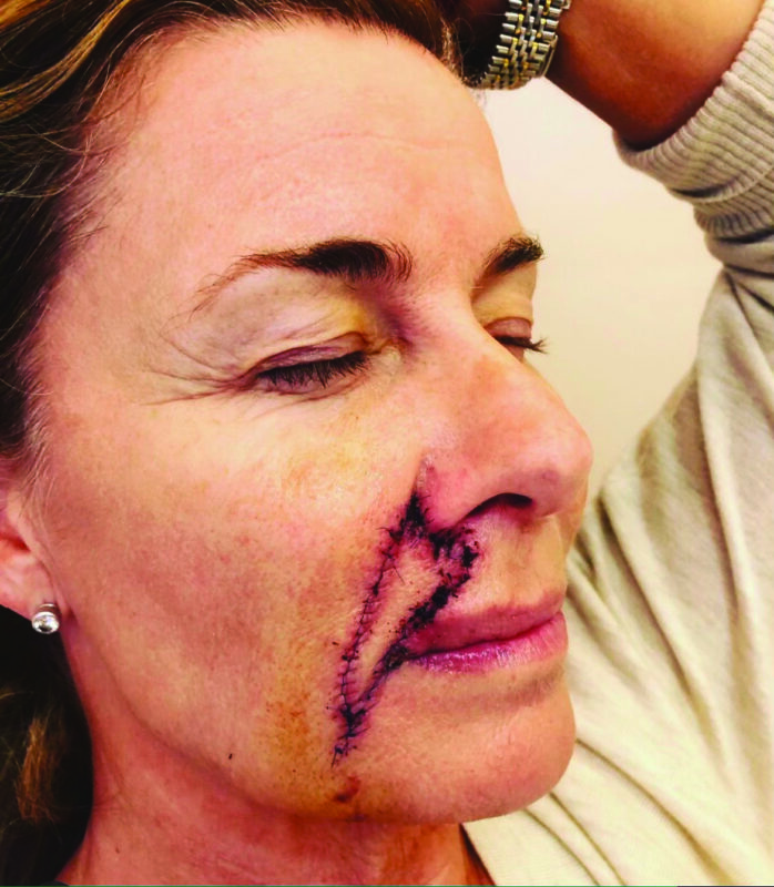 Deborah Hutton's viral photo of her post-surgery skin cancer scar.
